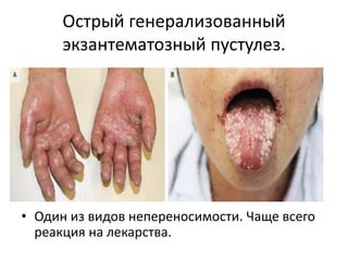 Спонгиоз + нейтрофилы
• Поищите также наличие грибков в роговом слое.
• Также поищите бактерии, потому что экзема
может осложняться бактериальной инфекцией.
• Если обнаружены акантолитические клетки, то их
сочетание с нейтрофильной инфильтрацией
эпидермиса требует исключения IgA-
пузырчатки. Это рассматривается в разделе
везикулобуллезного паттерна.
• Еще требуется рассмотреть возможность острого
генерализованного экзентамтозного пустулеза.
 