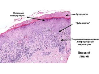 Гистология
• - типичный лихеноидный интерфейсный дерматит,
• - иногда выраженный акантоз,
• - иногда атрофия,
• - часто гиперкератоз,
• - не бывает паракератоза,
• - увеличена толщина зернистого слоя,
• - крупные гранулы в отдельных кератиноцитах,
• - нерегулярный паттерн «зубьев пилы»,
• - различное количество розовых телец апоптоза,
• - иногда между эпидермисом и сосочковой дермой образуется щель,
• - может образоваться булла и кровоизлияние,
• - лихеноидный лимфоцитарный инфильтрат чаще всего бывает
плотным.
 