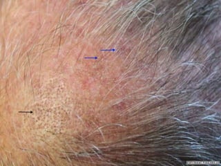 Плоский волосяной лишай
• Вариант плоского лишая, где главным местом
поражения является воронка волос скальпа.
• Клинически заболевание характеризуется
фолликулярными папулами на коже, рубцовой
алопецией на волосистой части головы,
внешне нерубцовой алопецией в
подмышечных складках и на лобке. Типичные
папулы красного плоского лишая иногда
обнаруживаются на слизистой оболочке
полости рта, реже на коже туловища.
 