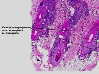 Гистология
• - вариант плоского лишая, где основным
местом повреждения является волосяная
воронка,
• - те же изменения, что и при плоском лишае,
но основные изменения в воронке,
• - приводит к разрушению фолликула и
алопеции,
• - типичен лимфоцитарный инфильтрат
перифолликулярно и признаки повреждения
волосяного фолликула.
 