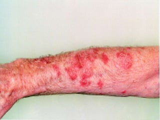 Лихеноидная лекарственная сыпь
LICHENOID DRUG ERUPTION
• Обычно развивается после воздействия солей
золота, тиазидовых диуретиков, ингибиторов
протонной помпы и реактивов для проявления
цветной фотопленки.
• - Обильная сыпь на туловище и конечностях.
• - Фотораспределение (больше выражена на местах,
подвергающихся действию солнечного света).
• - Сыпь может быть похожа на экзему и псориаз.
• - Довольно часто поражаются ногти и слизистые
оболочки. Картина как при плоском лишае.
• - После исчезновения оставляет пигментацию.
 