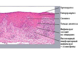 Гистология
• - похожа на плоский лишай,
• - может быть паракератоз,
• - в лимфоцитарном инфильтрате дермы может быть
примесь плазматических клеток и эозинофилов
 