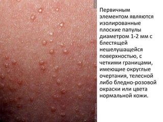 Блестящий лишай LICHEN NITIDUS
• Заболевание встречается чаще у детей.
• Первичным элементом являются изолированные
плоские папулы диаметром 1-2 мм с блестящей
нешелушащейся поверхностью.
• Наиболее часто сыпь располагается в области
коленных и локтевых суставов, на коже полового
члена.
• Редко сыпь имеет генерализованный характер и
может локализоваться на слизистых оболочках.
• Возможно поражение ладоней, подошв и ногтей.
• Субъективные ощущения обычно отсутствуют.
• Течение дерматоза может быть длительным.
 