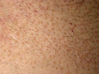 • Первичным
элементом являются
изолированные
плоские папулы
диаметром 1-2 мм с
блестящей
нешелушащейся
поверхностью, с
четкими границами,
имеющие округлые
очертания, телесной
либо бледно-розовой
окраски или цвета
нормальной кожи.
 