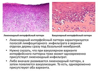 Интерфейсный паттерн
• Интерфейс – это граница раздела.
• Интерфейсными называют нарушения в эпидермисе
или в дерме, которые находятся вблизи этой границы.
 