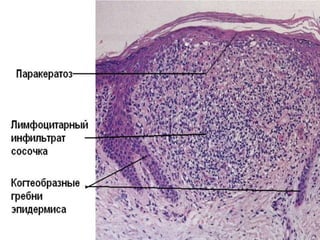 Гистология
• - минимальный лихеноидный лимфоцитарный
инфильтрат,
• - «когтеобразная» конфигурация эпидермиса с
изогнутыми удлиненными гребнями
эпидермиса вокруг лимфоцитарного
инфильтрата сосочковой дермы,
• - может быть паракератоз,
• - воспалительный инфильтрат может
распространяться на эпидермис.
 