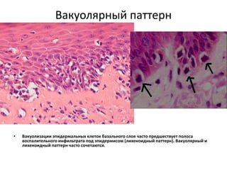 Вакуолярный интерфейсный паттерн
• Красная волчанка LUPUS ERYTHEMATOSUS
• Дерматополимиозит DERMATOMYOSITIS
• Группа многоформной эритемы ERYTHEMA
MULTIFORME GROUP
• - фиксированная лекарственная сыпь FIXED
DRUG ERUPTION
• -многоформная эритема ERYTHEMA
MULTIFORME
• -токсический эпидермальный некролиз TOXIC
EPIDERMAL NECROLYSIS
 