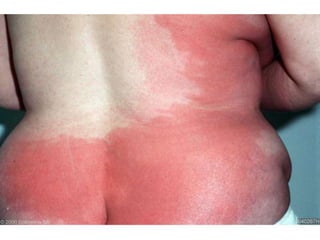 Фиксированная лекарственная эритема
• При повторных контактах с причинно-значимым
лекарственным средством или с веществом со
сходной антигенной структурой высыпания
повторяются каждый раз на одном и том же месте.
• В типичных случаях высыпания представлены
эритематозно-отечными элементами округлой или
овальной формы, размером от 2 см до 25-30 см с
четкими границами.
• В дальнейшем элементы уплотняются и
приобретают пурпурно-красную окраску.
• Иногда высыпания бывают в виде экзематозных,
уртикарных, везикулобуллезных, геморрагических
или узелковых элементов.
 