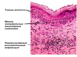 Гистология
• - отдельные и сгруппированные коллоидные тельца
апоптоза с эозинофильной цитоплазмой и
маленьким, темным ядром, либо без ядра.
• - спонгиоз и экзоцитоз лимфоцитов.
• - очаговые и слабовыраженные вакуолярные
интерфесные изменения.
• - периваскулярные лимфоцитарные инфильтраты в
сетчатой дерме. Могут присутствовать нейтрофилы
и эозинофилы.
• - может формироваться расщепление на уровне
дермоэпидермального соединения.
 