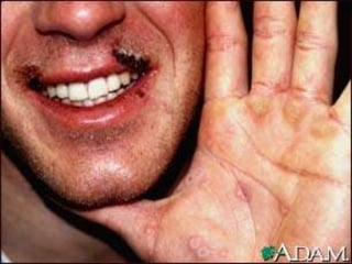 Многоформная эритема
• Рецидивирующая сыпь в форме бляшек,
похожих на крапивницу, но фиксированных.
Характерной особенностью являются
мишеневидные элементы. Могут возникать
эритематозные пятна и папулы.
• Локализация различная, в том числе на
ладонях и подошвах, а также на слизистых
оболочках.
• Причина идиопатическая, но может также
возникать при инфекции ВПН, микоплазме и
как реакция на лекарства.
 