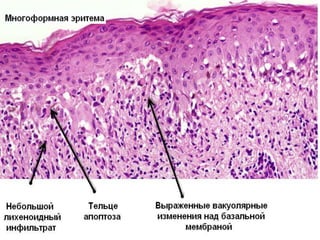 Гистология похожа на фиксированную
лекарственную эритему, но более яркая:
• - больше телец апоптоза.
• - более выражены вакуолярные
интерфейсные изменения.
• - могут быть буллы с геморрагическим
содержимым.
• - часто периваскулярные геморрагии.
• Для постановки диагноза обязательны:
вакуолярные интерфейсные изменения и
тельца апоптоза.
 