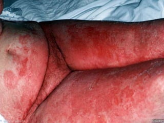 Токсический эпидермальный некролиз
(синдром Стивенса-Джонсона, Лайела).
• Клинические проявления:
• - тяжелое, угрожающее жизни течение,
• - крупные, дряблые, сливающиеся пузыри,
которые могут распространиться на всю
поверхность кожи,
• - чаще всего является реакцией на
лекарства. Во многих случаях причина
неясная.
 