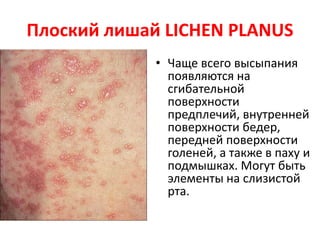 Вакуолярный интерфейсный паттерн
• Красная волчанка LUPUS ERYTHEMATOSUS
• Дерматополимиозит DERMATOMYOSITIS
• Группа многоформной эритемы ERYTHEMA
MULTIFORME GROUP
• - фиксированная лекарственная сыпь FIXED
DRUG ERUPTION
• -многоформная эритема ERYTHEMA
MULTIFORME
• -токсический эпидермальный некролиз TOXIC
EPIDERMAL NECROLYSIS
 