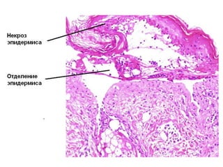 Гистология
• - некроз эпидермиса на всю глубину,
• - эпидермис отделяется от дермы и формируются
буллы,
• - по краям буллы некротические кератиноциты,
• - присутствие клеток воспаления вариабельное.
•
• Дифференциальный диагноз:
• Стафилококковый синдром ошпаренной кожи
(расщепление эпидермиса на уровне зернистого
слоя).
 
