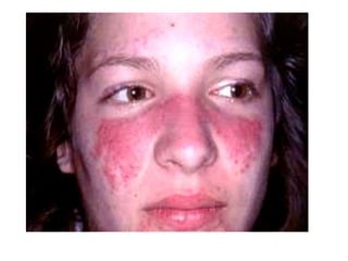 Острая кожная красная волчанка
• Специфическая сыпь в форме «бабочки»
(покраснение и отек, носогубная область не
затронута)
• Эритематозная папулезная сыпь на руках,
иногда в форме больших бляшек. Может быть
и других локализаций.
• Фоточувствительность (сыпь на местах
открытых солнцу).
• Хейлит и афты во рту
• Буллы и эрозии
 