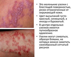 Плоский лишай LICHEN PLANUS
• Чаще всего высыпания
появляются на
сгибательной
поверхности
предплечий, внутренней
поверхности бедер,
передней поверхности
голеней, а также в паху и
подмышках. Могут быть
элементы на слизистой
рта.
 