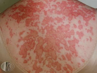 Подострая кожная красная волчанка
• Вызывается или усиливается солнечным
светом
• Псориазоподобные элементы на спине,
груди и плечах
• Кольцевидные или полициклические
бляшки с центральным очищением
• Выздоровление без рубцов
 