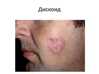 Хроническая кожная красная волчанка
• Дискоидная
• Гипертрофическая
 