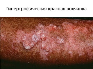Гипертрофическая красная волчанка
 