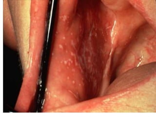 • Это маленькие узелки с
блестящей поверхностью,
резко отграниченные от
окружающей кожи.
• Цвет высыпаний густо-
красный, синюшный, а
иногда и буроватый.
• В центре отдельных
узелков имеется
пупкообразное
вдавление.
• Узелки могут сливаться,
образуя бляшки, на
которых можно заметить
своеобразный сетчатый
рисунок
 