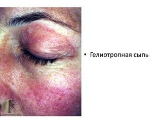 Дерматополимиозит
• Красноватые или пурпурные бляшки, чаще в
зонах солнечного облучения
• Пурпурные веки – гелиотропная сыпь.
• Пурпурные папулы на местах выступающих
костей – папулы Готтрона
• Зазубренные края и телеангиэктазии ногтевых
лож
• Сыпь на щеках, носу, плечах, груди и локтях
• Реже пойкилодермия
 