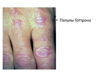 • Гелиотропная сыпь
 