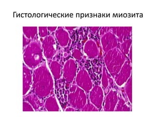 Гистология
• Гистологические изменения кожи такие же
как при волчанке
• Иммунофлюоресценция также может
обнаружить «волчаночную полосу»
 