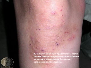Высыпания могут быть представлены тремя
типами элементов: крошечными везикулами,
папулами и уртикарными бляшками,
организованными в группы.
 