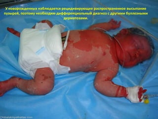Эпидермолитический гиперкератоз
EPIDERMOLYTIC HYPERKERATOSIS• Аутосомнодоминантное наследование. Дефект в генах
кератина 1 и кератина 10.
• Болезнь проявляется с рождения генерализованной эритемой с
тяжелым гиперкератозом.
• Роговые чешуйки мелкие плотные.
• На сгибательной поверхности суставов, в том числе в
подмышечных впадинах, подколенных и локтевых ямках, на
шее и в области тазобедренных суставов образуются
изолированные параллельные гиперкератотические гребешки с
бородавчатым разрастанием.
• Эритема после одного года бледнеет, но гиперкератоз
сохраняется на всю жизнь.
• У новорожденных наблюдается рецидивирующее
распространенное высыпание пузырей, поэтому необходим
дифференциальный диагноз с другими буллезными
дерматозами.
 