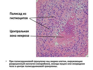 • При палисадниковой гранулеме мы видим клетки, окружающие
разрушенный коллаген (некробиоз), иногда муцин или инородное
тела в центре палисадниковой гранулемы.
 