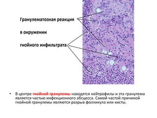 • В центре гнойной гранулемы находятся нейтрофилы и эта гранулема
является частью инфекционного абсцесса. Самой частой причиной
гнойной гранулемы являются разрыв фолликула или кисты.
 