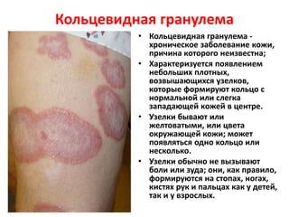 Кольцевидная гранулема
• Кольцевидная гранулема -
хроническое заболевание кожи,
причина которого неизвестна;
• Характеризуется появлением
небольших плотных,
возвышающихся узелков,
которые формируют кольцо с
нормальной или слегка
западающей кожей в центре.
• Узелки бывают или
желтоватыми, или цвета
окружающей кожи; может
появляться одно кольцо или
несколько.
• Узелки обычно не вызывают
боли или зуда; они, как правило,
формируются на стопах, ногах,
кистях рук и пальцах как у детей,
так и у взрослых.
 