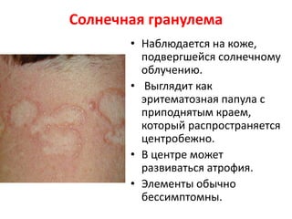 Солнечная гранулема
• Наблюдается на коже,
подвергшейся солнечному
облучению.
• Выглядит как
эритематозная папула с
приподнятым краем,
который распространяется
центробежно.
• В центре может
развиваться атрофия.
• Элементы обычно
бессимптомны.
 