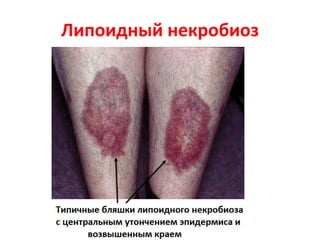 Липоидный некробиоз
 