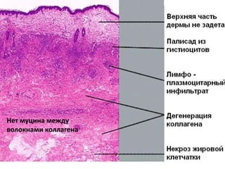 Нет муцина между
волокнами коллагена
 