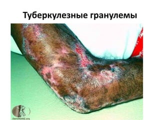 Туберкулезные гранулемы
 