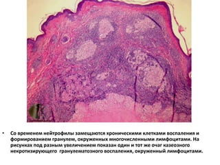 • Со временем нейтрофилы замещаются хроническими клетками воспаления и
формированием гранулем, окруженных многочисленными лимфоцитами. На
рисунках под разным увеличением показан один и тот же очаг казеозного
некротизирующего гранулематозного воспаления, окруженный лимфоцитами.
 