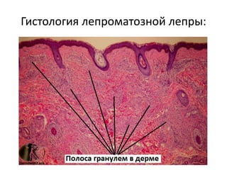 Гистология лепроматозной лепры:
 