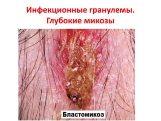 Инфекционные гранулемы.
Глубокие микозы
 