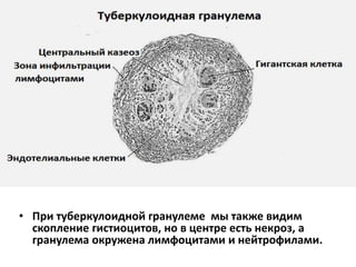 • При туберкулоидной гранулеме мы также видим
скопление гистиоцитов, но в центре есть некроз, а
гранулема окружена лимфоцитами и нейтрофилами.
 