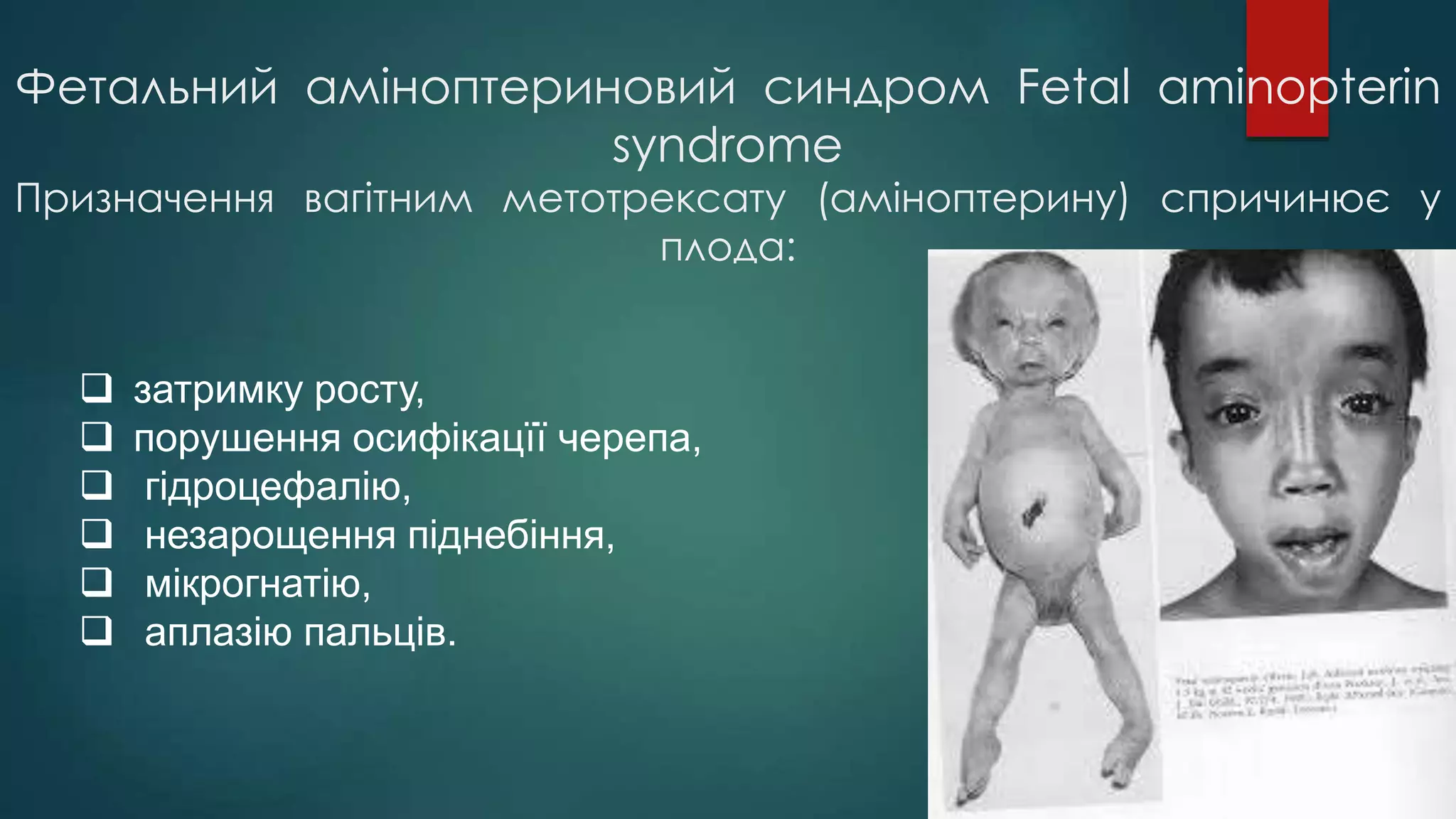 Фетальний аміноптериновий синдром Fetal aminopterin
syndrome
Призначення вагітним метотрексату (аміноптерину) спричинює у
плода:
 затримку росту,
 порушення осифікацїї черепа,
 гідроцефалію,
 незарощення піднебіння,
 мікрогнатію,
 аплазію пальців.
 