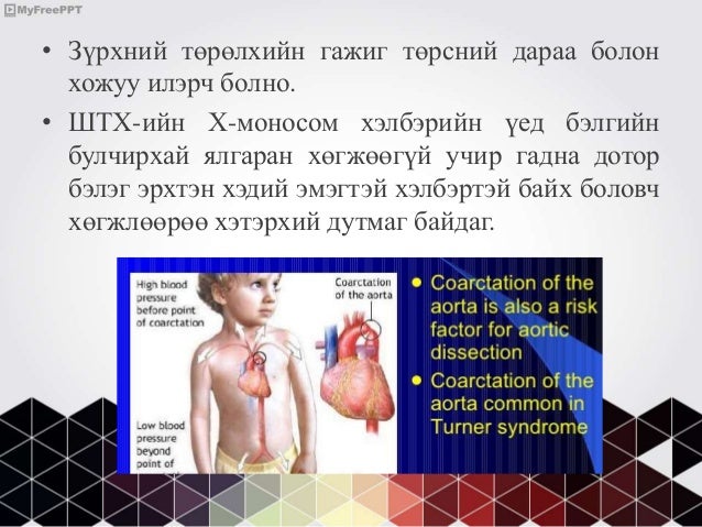 бэлгийн хромосомын эмгэгүүд