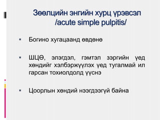 Зөөлцийн энгийн хурц үрэвсэл
/acute simple pulpitis/
 Богино хугацаанд өвдөнө
 ШЦӨ, элэгдэл, гэмтэл зэргийн үед
хөндийг хэлбэржүүлэх үед тугалмай ил
гарсан тохиолдолд үүснэ
 Цоорлын хөндий нээгдээгүй байна
 