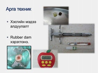 Арга техник
 Хэсгийн мэдээ
алдуулалт
 Rubber dam
хэрэглэнэ.
 