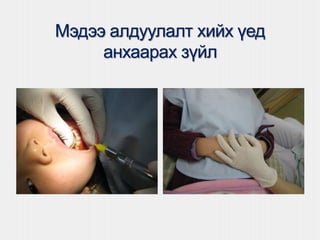 Мэдээ алдуулалт хийх үед
анхаарах зүйл
 