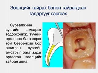 Зөөлцийг тайрах болон тайрагдсан
гадаргууг сэргээх
Сурвалжийн
сувгийн амсарыг
тодорхойлж, түүний
өргөнөөс бага зэрэг
том бөөрөнхий бор
ашиглан сувгийн
амсарыг бага зэрэг
өргөсгөн зөөлцийг
тайран авна.
 