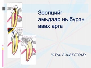 VITAL PULPECTOMY
Зөөлцийг
амьдаар нь бүрэн
авах арга
 