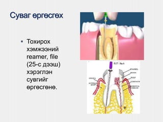 Суваг өргөсгөх
 Тохирох
хэмжээний
reamer, file
(25-с дээш)
хэрэглэн
сувгийг
өргөсгөнө.
 
