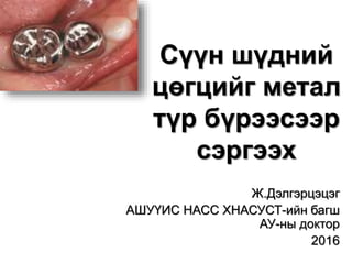 Сүүн шүдний
цөгцийг метал
түр бүрээсээр
сэргээх
Ж.Дэлгэрцэцэг
АШУҮИС НАСС ХНАСУСТ-ийн багш
АУ-ны доктор
2016
 