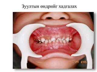 Зуултын өндрийг хадгалах
 